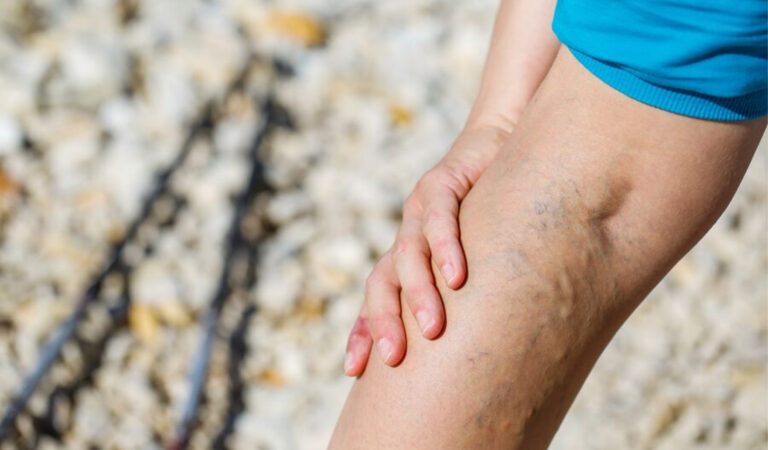 Effective home remedies for the natural elimination of varicose veins